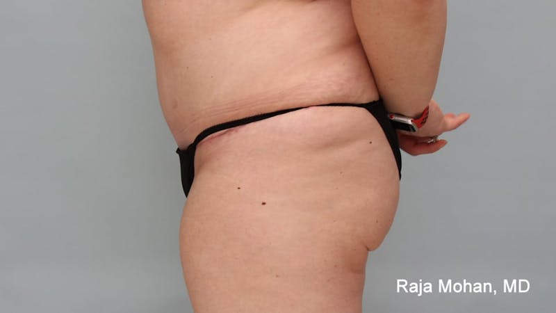 Tummy Tuck Before & After Gallery - Patient 190559 - Image 4