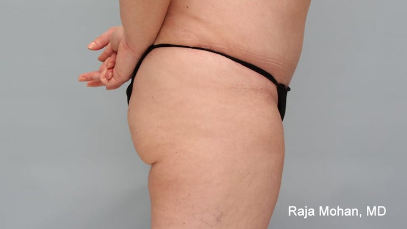 Tummy Tuck Before & After Gallery - Patient 190559 - Image 6