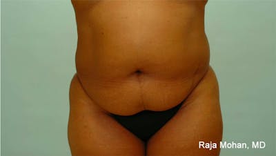 Tummy Tuck Before & After Gallery - Patient 997452 - Image 1