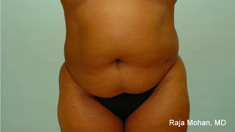 Tummy Tuck Before & After Gallery - Patient 997452 - Image 1