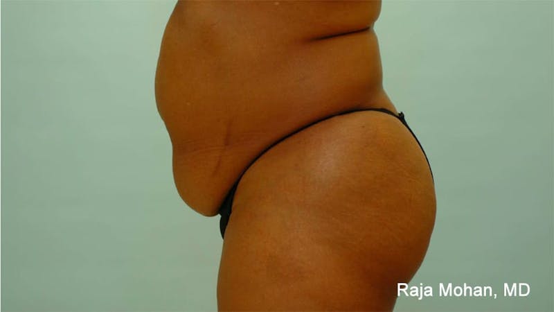 Tummy Tuck Before & After Gallery - Patient 997452 - Image 3