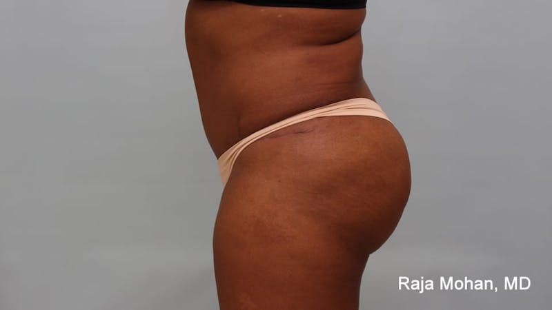 Tummy Tuck Before & After Gallery - Patient 997452 - Image 4