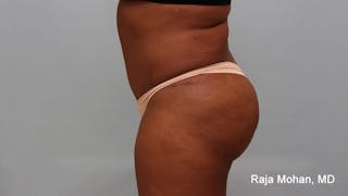 Tummy Tuck Before & After Gallery - Patient 997452 - Image 4