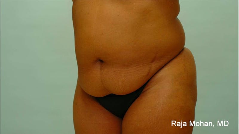 Tummy Tuck Before & After Gallery - Patient 997452 - Image 5
