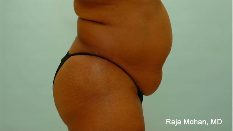 Tummy Tuck Before & After Gallery - Patient 997452 - Image 7