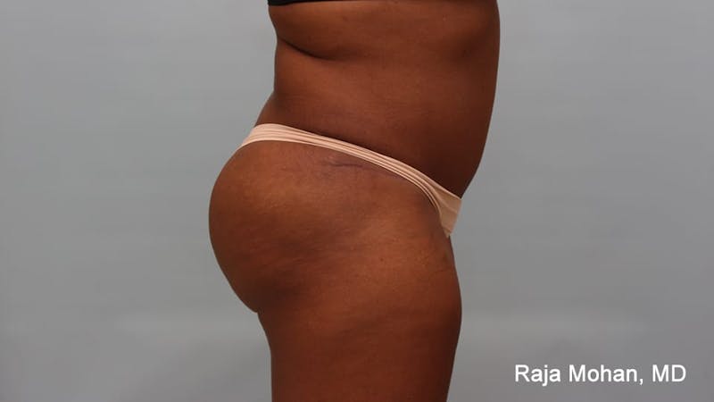 Tummy Tuck Before & After Gallery - Patient 997452 - Image 8