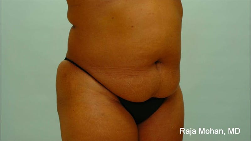 Tummy Tuck Before & After Gallery - Patient 997452 - Image 9