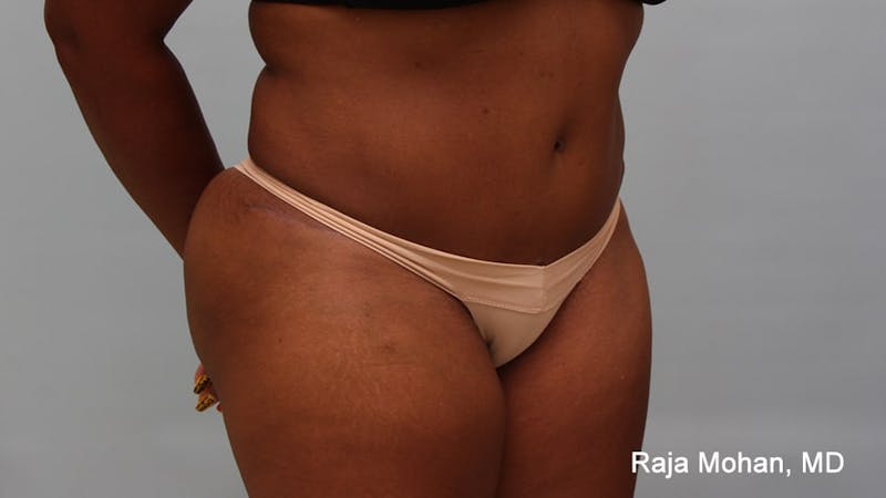 Tummy Tuck Before & After Gallery - Patient 997452 - Image 10