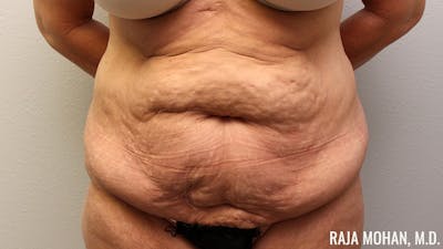 Tummy Tuck Before & After Gallery - Patient 346536 - Image 1