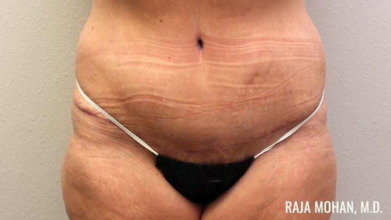 Tummy Tuck Before & After Gallery - Patient 346536 - Image 2