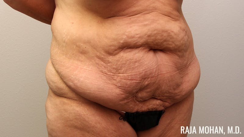 Tummy Tuck Before & After Gallery - Patient 346536 - Image 3