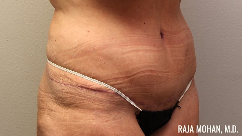 Tummy Tuck Before & After Gallery - Patient 346536 - Image 4