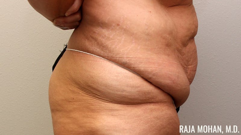 Tummy Tuck Before & After Gallery - Patient 346536 - Image 5