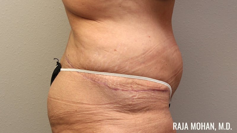 Tummy Tuck Before & After Gallery - Patient 346536 - Image 6