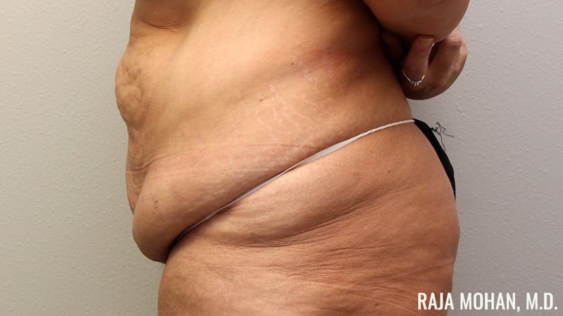 Tummy Tuck Before & After Gallery - Patient 346536 - Image 7