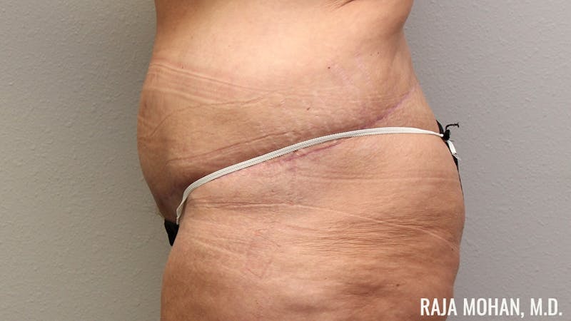 Tummy Tuck Before & After Gallery - Patient 346536 - Image 8