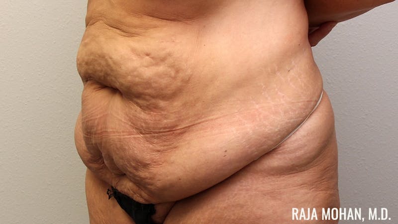Tummy Tuck Before & After Gallery - Patient 346536 - Image 9
