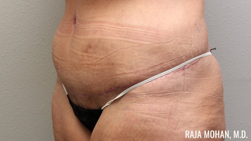 Tummy Tuck Before & After Gallery - Patient 346536 - Image 10