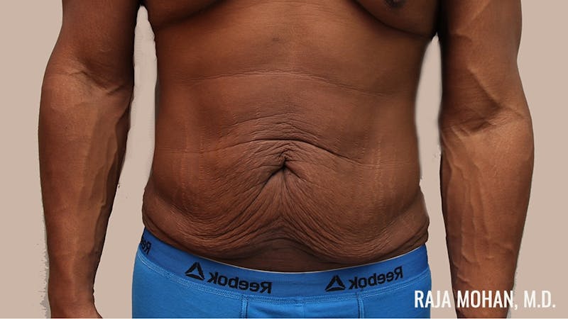 Tummy Tuck Before & After Gallery - Patient 427831 - Image 1