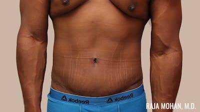 Tummy Tuck Before & After Gallery - Patient 427831 - Image 2
