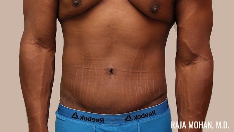 Tummy Tuck Before & After Gallery - Patient 427831 - Image 2
