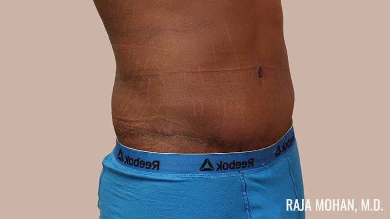 Tummy Tuck Before & After Gallery - Patient 427831 - Image 4