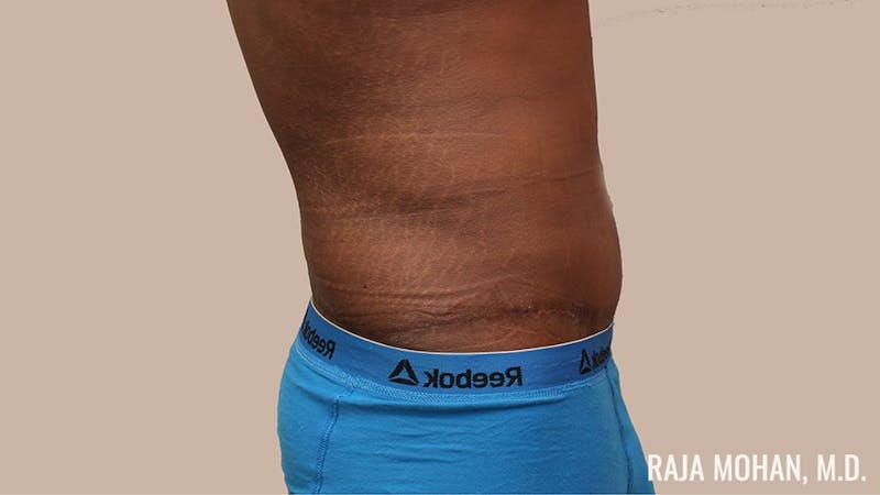 Tummy Tuck Before & After Gallery - Patient 427831 - Image 6