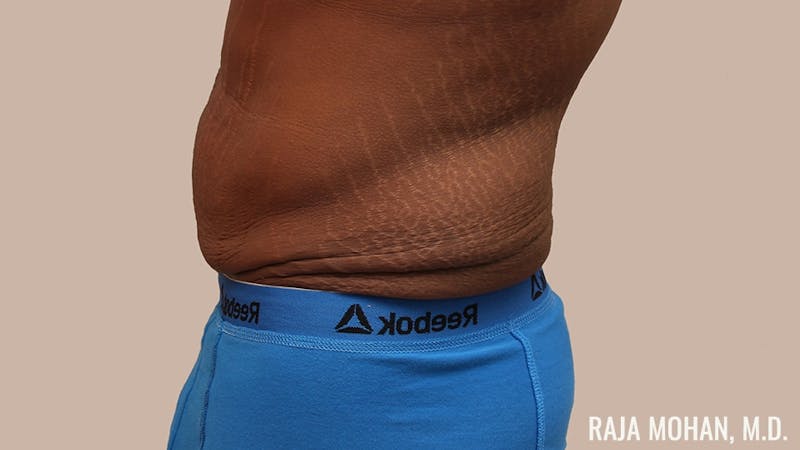 Tummy Tuck Before & After Gallery - Patient 427831 - Image 7