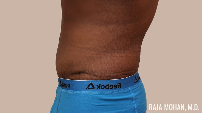Tummy Tuck Before & After Gallery - Patient 427831 - Image 8