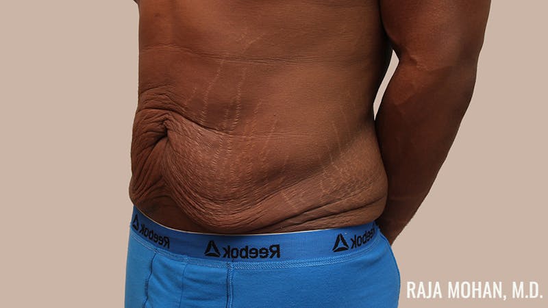 Tummy Tuck Before & After Gallery - Patient 427831 - Image 9