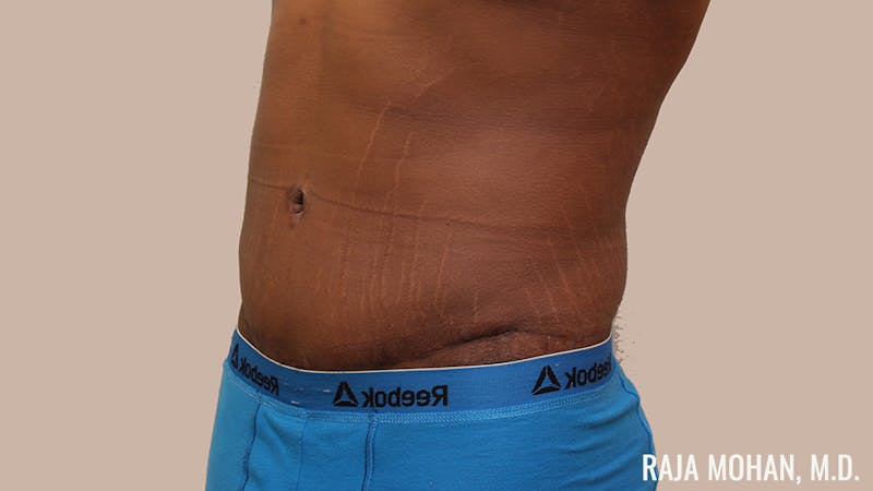 Tummy Tuck Before & After Gallery - Patient 427831 - Image 10
