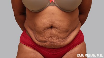 Tummy Tuck Before & After Gallery - Patient 299587 - Image 1