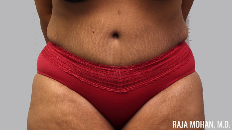 Tummy Tuck Before & After Gallery - Patient 299587 - Image 2