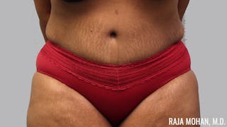 Tummy Tuck Before & After Gallery - Patient 299587 - Image 2