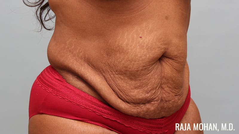 Tummy Tuck Before & After Gallery - Patient 299587 - Image 3