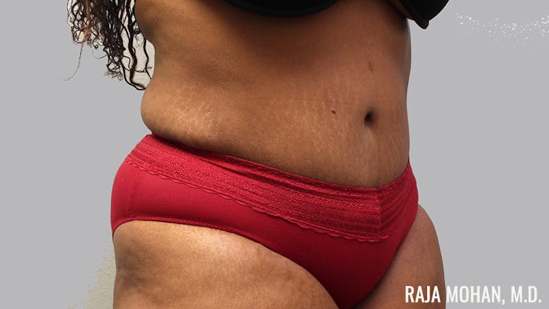 Tummy Tuck Before & After Gallery - Patient 299587 - Image 4