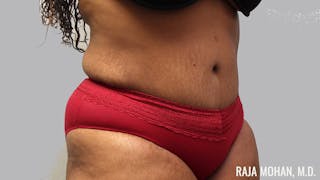 Tummy Tuck Before & After Gallery - Patient 299587 - Image 4