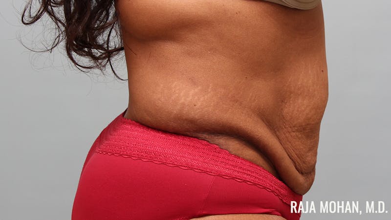 Tummy Tuck Before & After Gallery - Patient 299587 - Image 5
