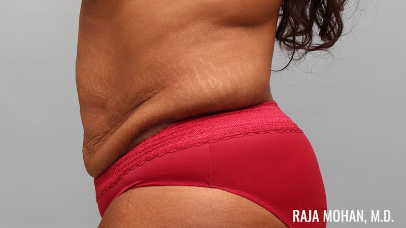 Tummy Tuck Before & After Gallery - Patient 299587 - Image 7