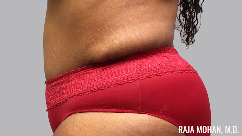 Tummy Tuck Before & After Gallery - Patient 299587 - Image 8