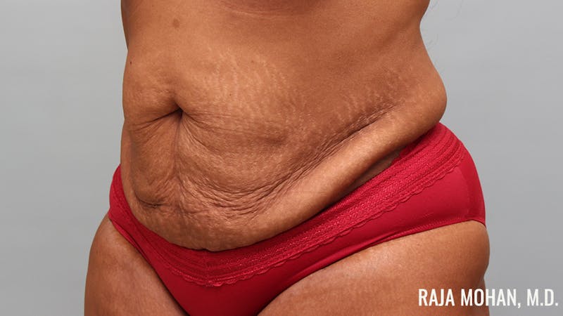 Tummy Tuck Before & After Gallery - Patient 299587 - Image 9