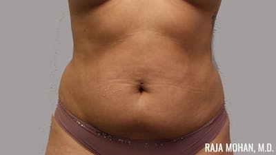 Tummy Tuck Before & After Gallery - Patient 154017 - Image 1