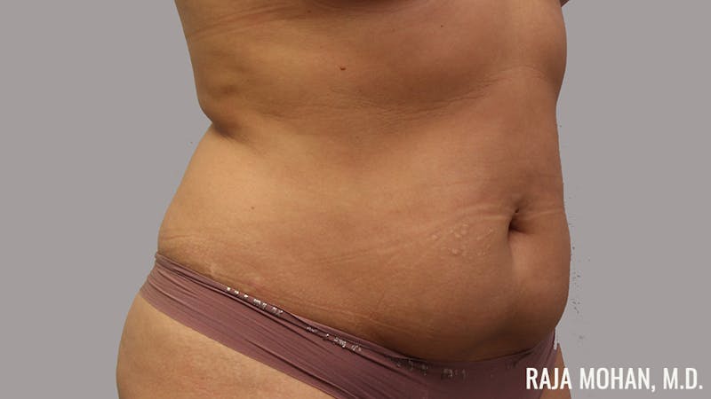 Tummy Tuck Before & After Gallery - Patient 154017 - Image 3