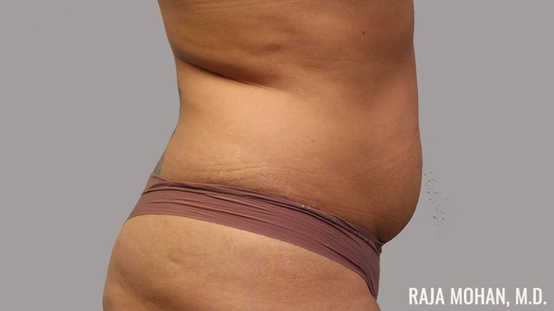 Tummy Tuck Before & After Gallery - Patient 154017 - Image 5