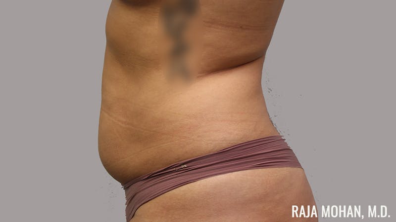 Tummy Tuck Before & After Gallery - Patient 154017 - Image 7