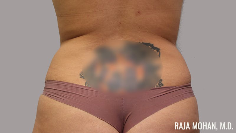 Tummy Tuck Before & After Gallery - Patient 154017 - Image 9