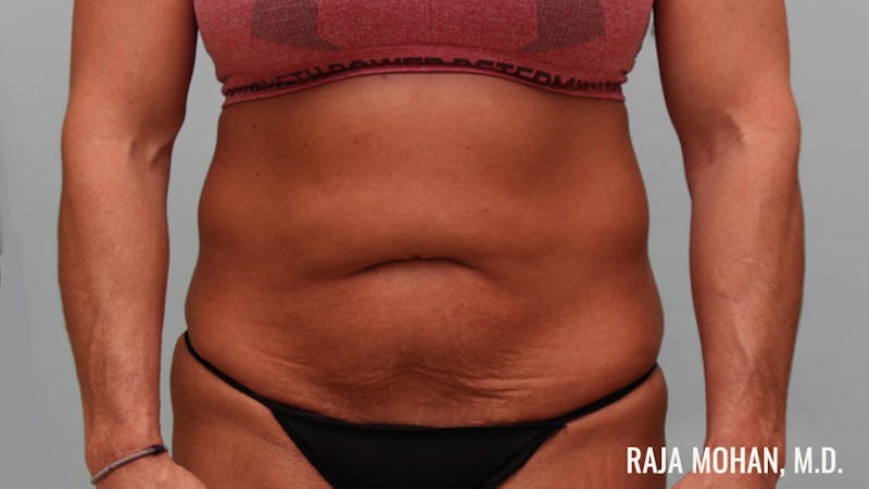 Tummy Tuck Before & After Gallery - Patient 376337 - Image 1