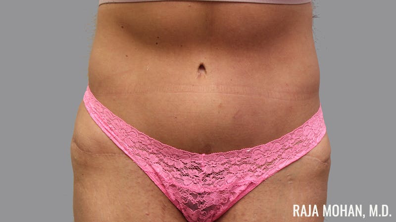 Tummy Tuck Before & After Gallery - Patient 376337 - Image 2