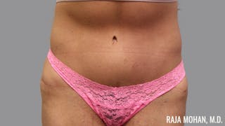Tummy Tuck Before & After Gallery - Patient 376337 - Image 2