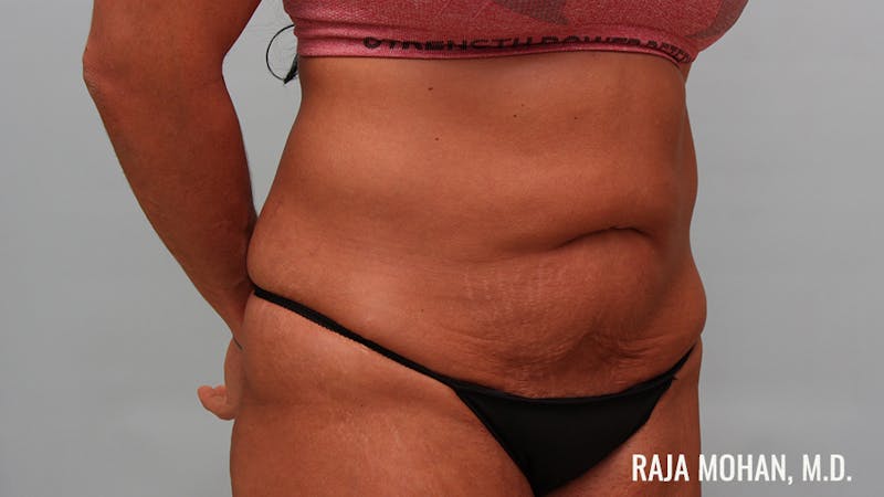 Tummy Tuck Before & After Gallery - Patient 376337 - Image 3